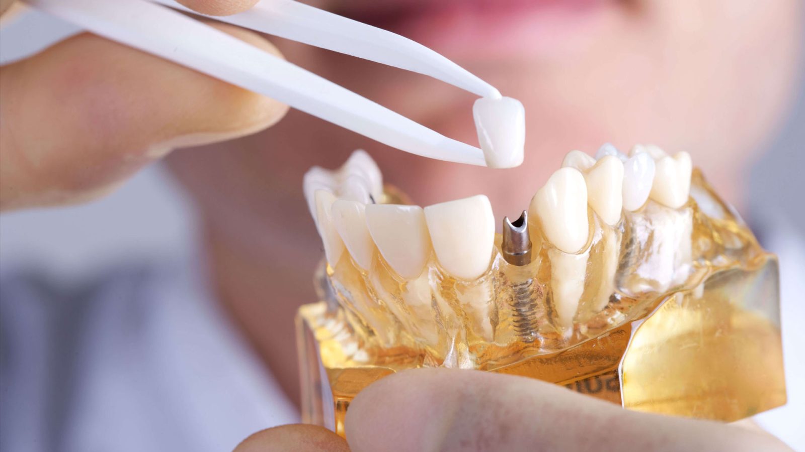 الأسئلة والأجوبة المتداولة حول زراعة الأسنان