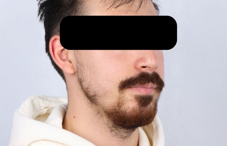 Mr. Taner orthognatic After 1