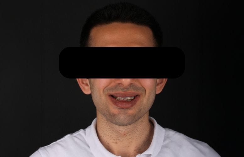 Mr. Cihan orthognatic Before 1