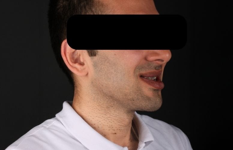 Mr. Cihan orthognatic Before 2