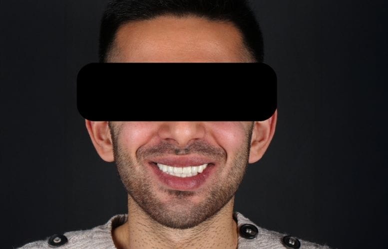 Mr. Cihan orthognatic after 2