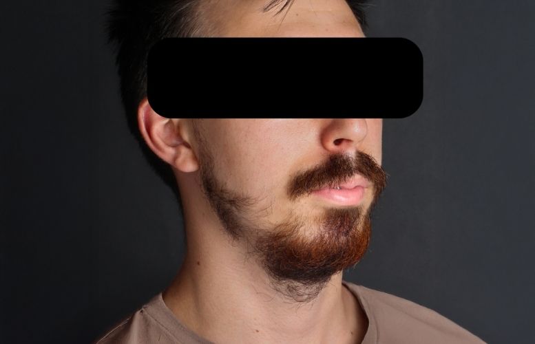 Mr. Taner orthognatic Before 2