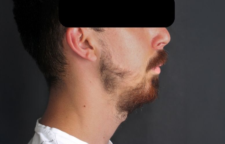 Mr. Taner orthognatic Before 1
