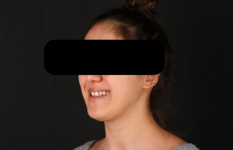 Orthognatic Before image of F.G 2