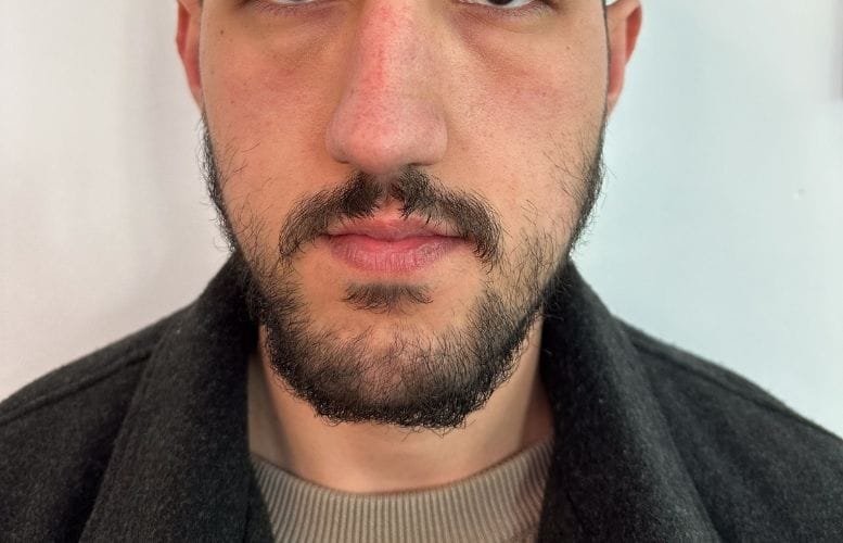 Mr. Emre othognatic before 2