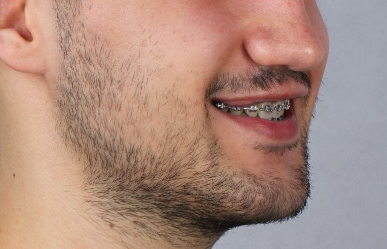 Mr. Emre othognatic after 1