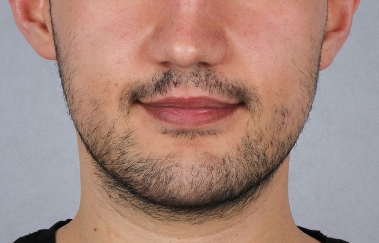 Mr. Emre othognatic after 2