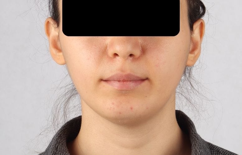 Orthognatic After image of f.g1