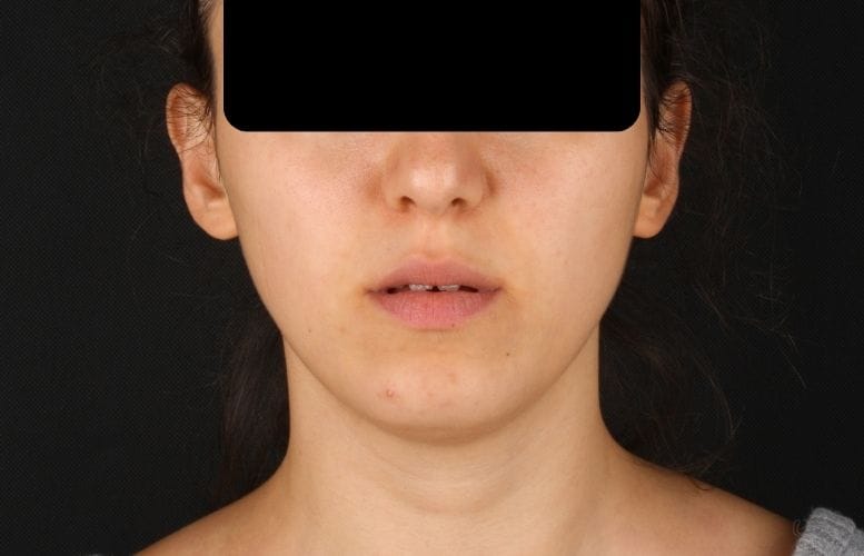 Orthognatic Before image of F.G1